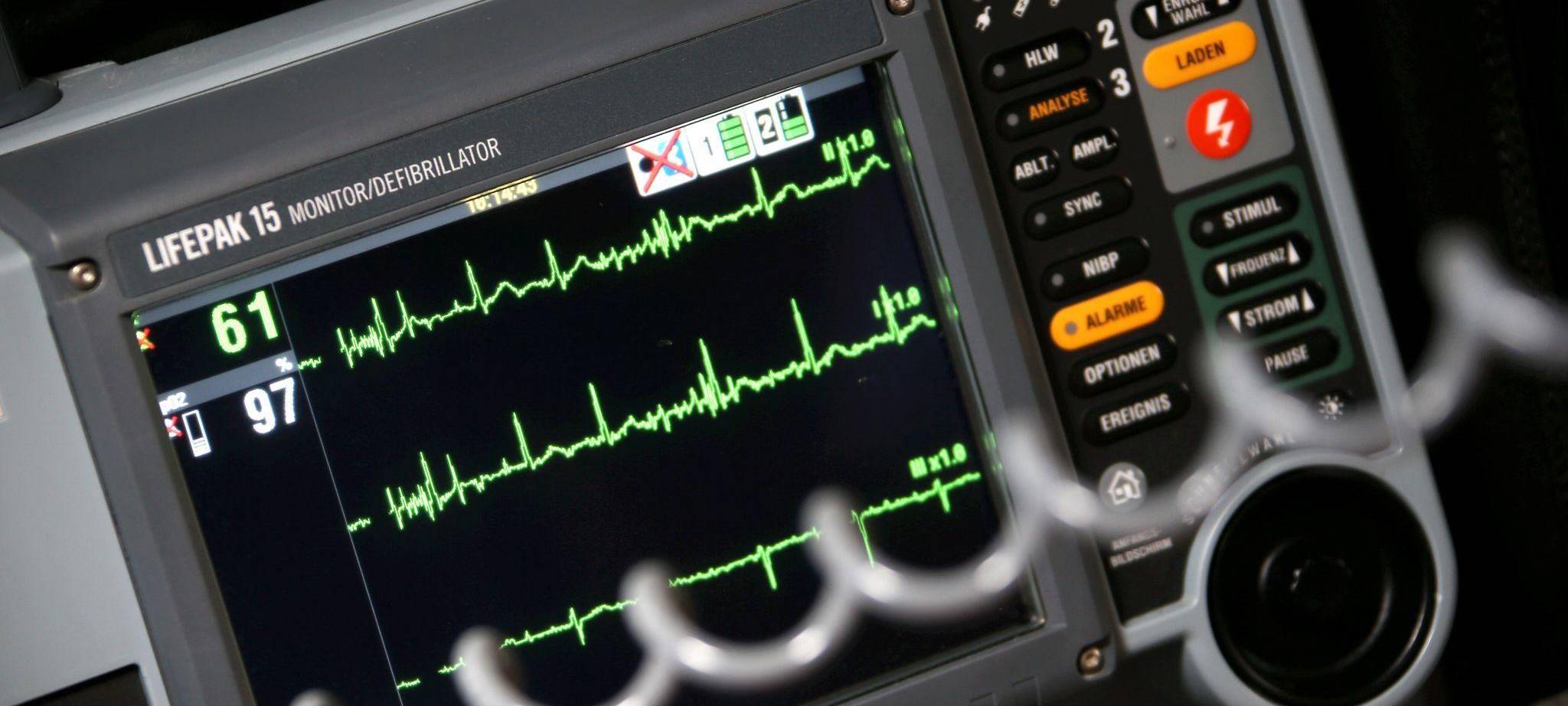 Sinusrhytmus eines Herzens ist auf einem EKG zu sehen